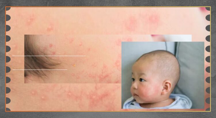 Ruam dan Diare Setelah Susu Waspadai Alergi Anak