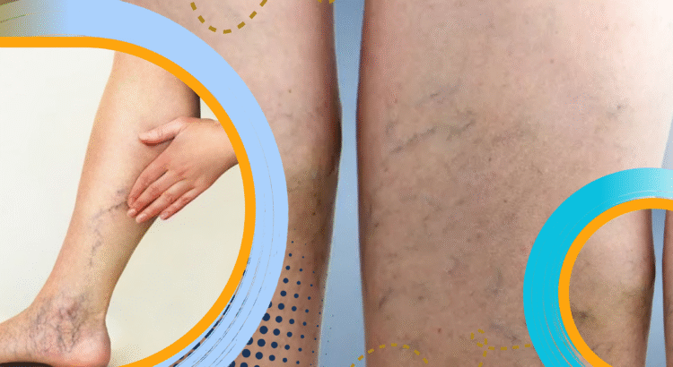 Gejala Varises yang Sering Diabaikan dan Risikonya