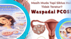 PCOS dan Haid Tidak Teratur, Kenali Gejalanya Sejak Dini