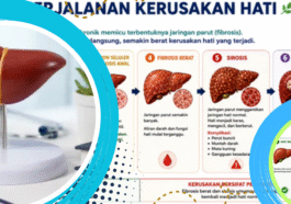 Deteksi Dini Jadi Kunci Cegah Penyakit Hati Kronis