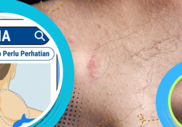 Lipoma Gejala, Penyebab, dan Cara Mengobatinya