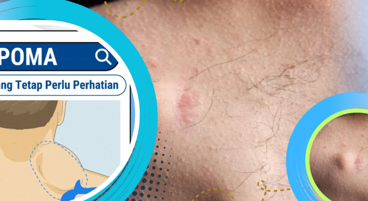 Lipoma Gejala, Penyebab, dan Cara Mengobatinya