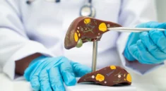 Deteksi Dini Hepatitis B dan C Lindungi Kesehatan Hati
