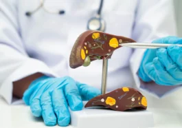 Deteksi Dini Hepatitis B dan C Lindungi Kesehatan Hati