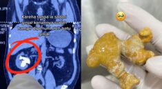 Dokter Ungkap Penyebab Batu Ginjal Makin Banyak Terjadi