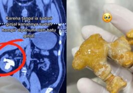 Dokter Ungkap Penyebab Batu Ginjal Makin Banyak Terjadi