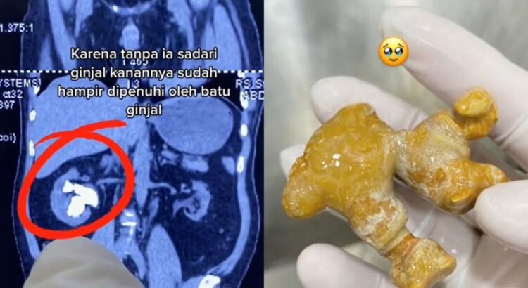 Dokter Ungkap Penyebab Batu Ginjal Makin Banyak Terjadi