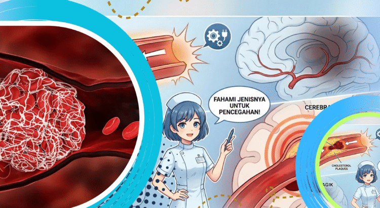 Gumpalan Darah Berbahaya, Kenali Risiko dan Pencegahannya