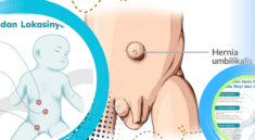 Hernia pada Anak Bisa Berbahaya, Kenali Gejalanya Sejak Dini