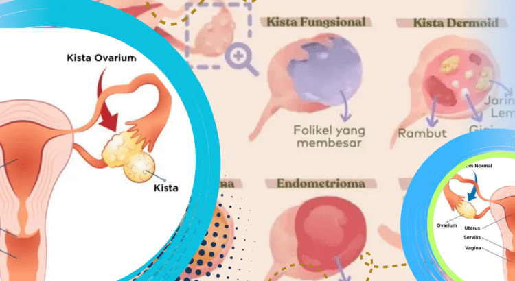 Kista Ovarium Jenis yang Aman dan Tanda Bahayanya