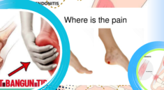 Nyeri Tumit Saat Bangun Tidur Kenali Plantar Fasciitis