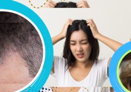 3 Penyebab Kulit Kepala Gatal dan Cara Mengatasinya