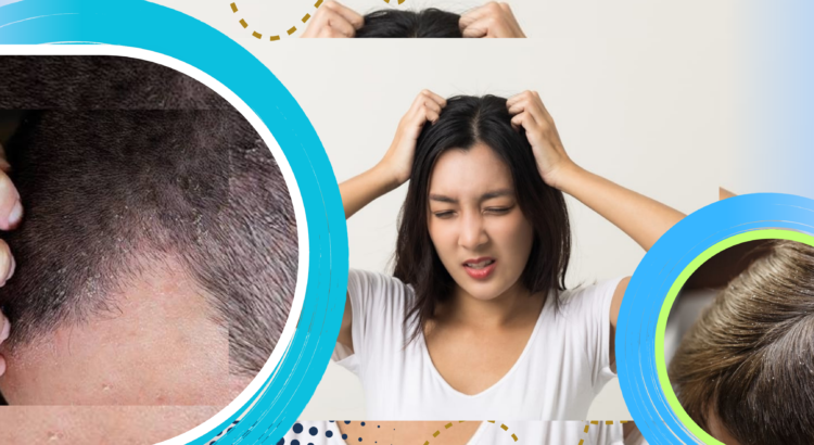 3 Penyebab Kulit Kepala Gatal dan Cara Mengatasinya