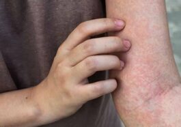 Kanker Langka Fakta, Risiko, dan Tantangan Diagnosis